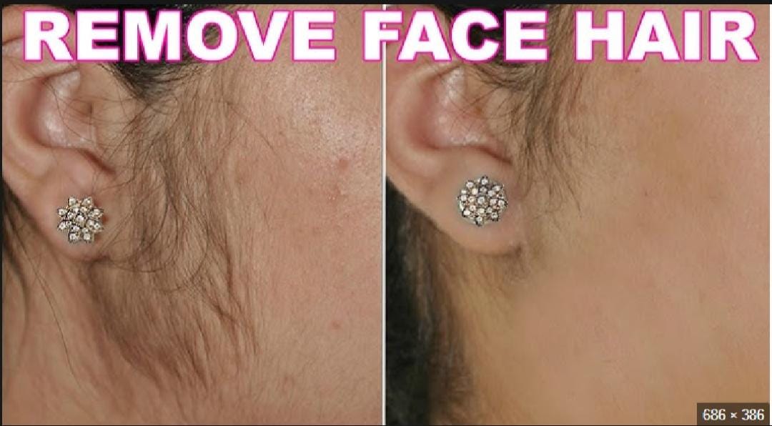 Sydonic Permanent Facial Hair removal Treatment